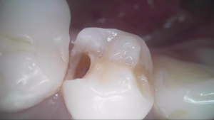 詰め物 た の 歯 取れ 詰め物・被せ物が取れたらどうする？正しい対応方法｜歯科衛生士がお口の悩みに答えます